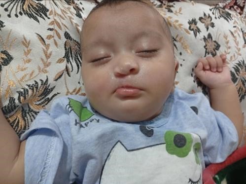 نتیجه موفق جراحی شکاف لب