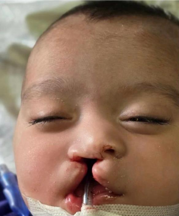 شکاف لب - قبل از درمان