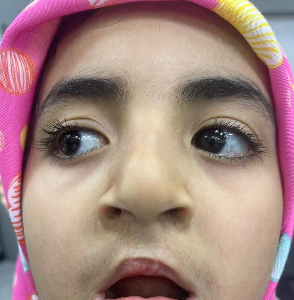 شکاف لب دو طرفه - بعد