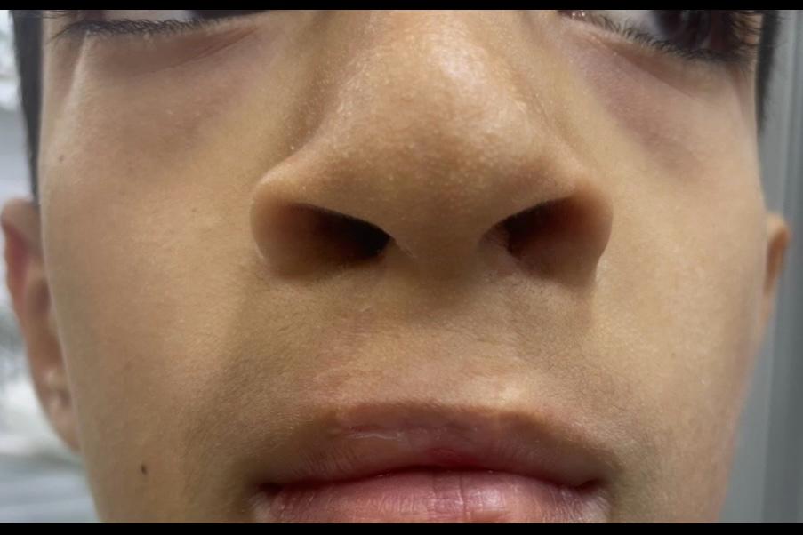 نتیجه جراحی شکاف لب