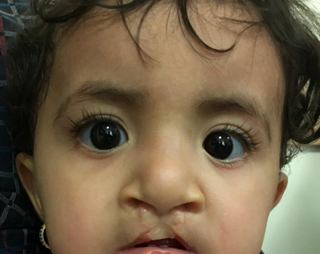 شکاف لب دو طرفه - قبل