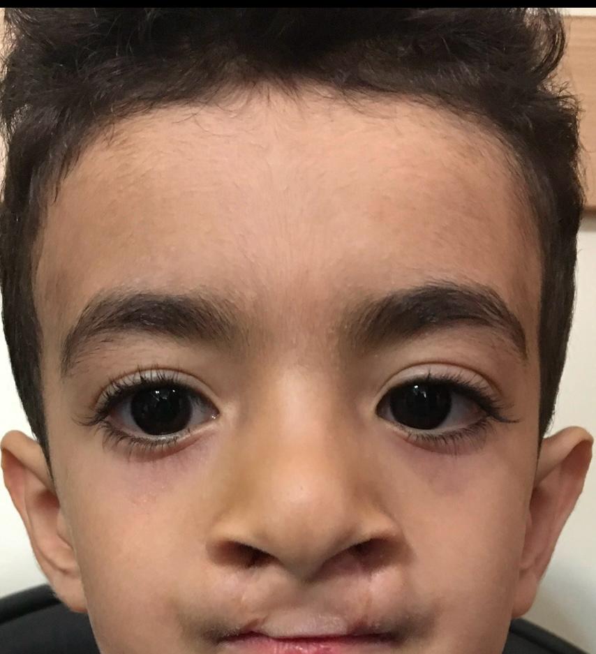 شکاف لب - قبل از جراحی