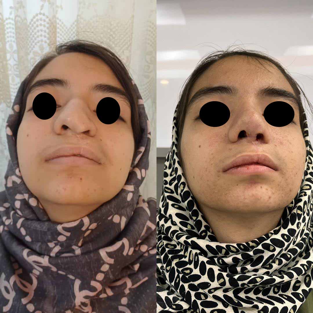 ناهنجاری بینی و فک - بعد