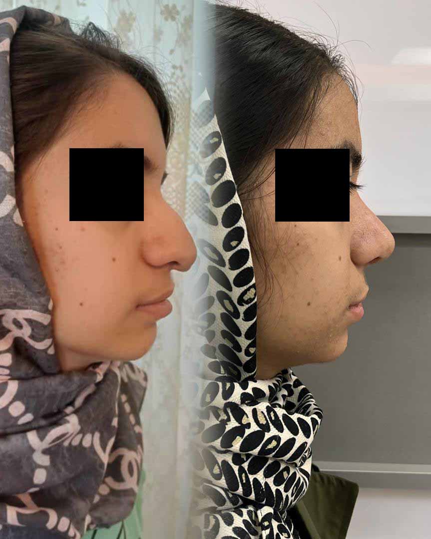 ناهنجاری بینی و فک - قبل